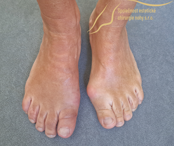 post-operative photo of right bunion 12 weeks after surgery